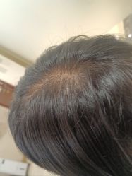 -碧莲盛·不剃发植发