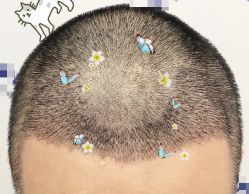 -大麦微针植发全国连锁