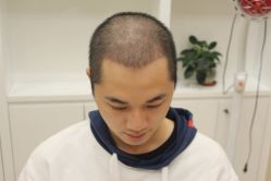 点击看大图 -大麦微针植发丨全国连锁