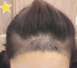 -大麦微针植发丨全国连锁