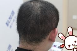 点击看大图 -大麦微针植发丨全国连锁