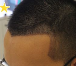 -大麦微针植发丨全国连锁