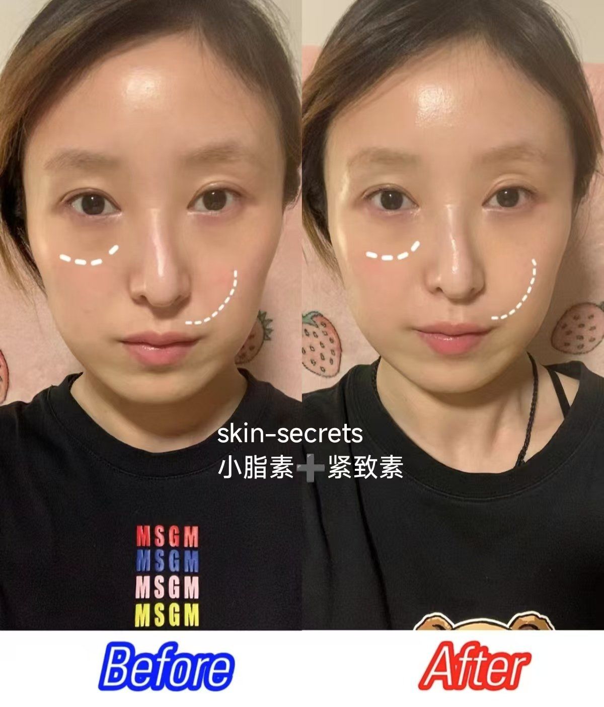 小脂素77紧致素 没有恢复期的轮廓管理