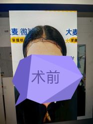 -大麦微针植发全国连锁