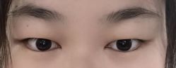 体验前-丰联丽格医疗美容·联合丽格眼整形中心