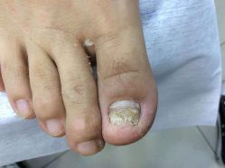 -德哥灰指甲脚气甲沟炎跖疣护理