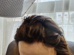 -碧莲盛·不剃发植发