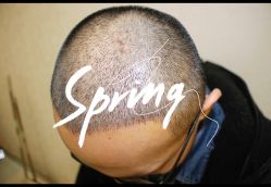 体验后-大麦微针植发全国连锁