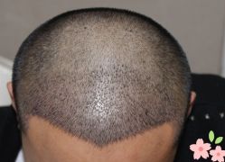 -大麦微针植发丨全国连锁