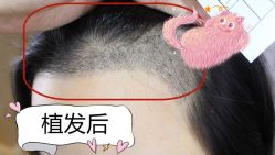 -大麦微针植发全国连锁