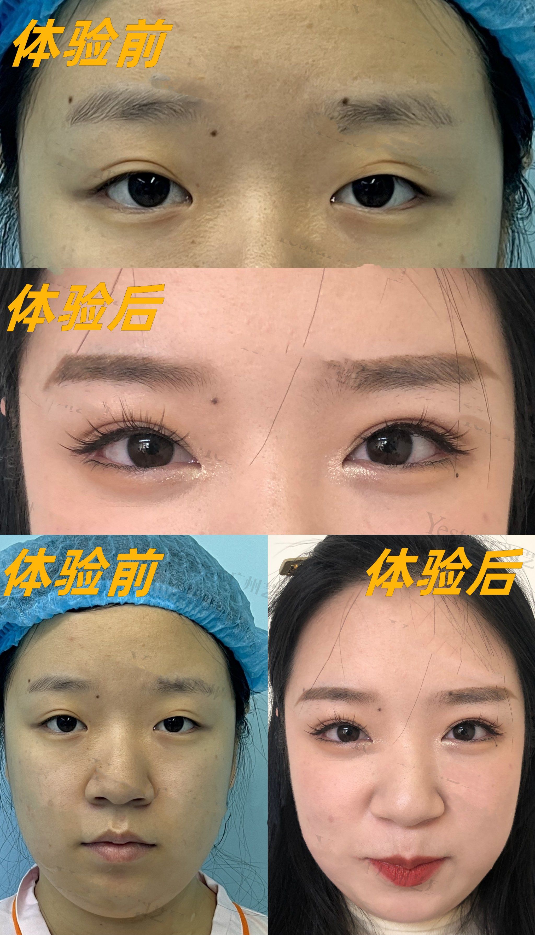 眼综合前后一个月对比