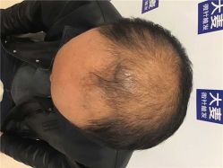 -大麦微针植发丨全国连锁
