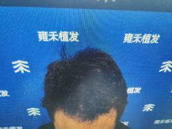 -雍禾植发全国连锁