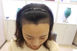 -大麦微针植发丨全国连锁