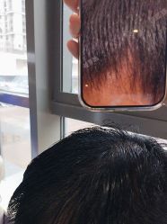 -碧莲盛·不剃发植发