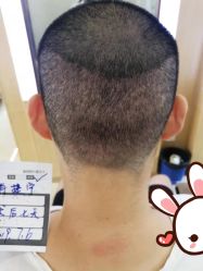 -大麦微针植发丨全国连锁