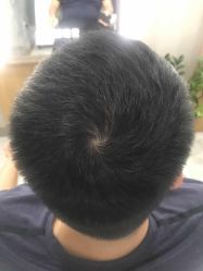 -大麦微针植发全国连锁