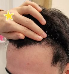 -大麦微针植发丨全国连锁