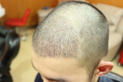 点击看大图 -大麦微针植发丨全国连锁