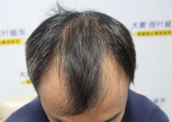 -大麦微针植发丨全国连锁