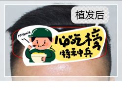 -大麦微针植发全国连锁