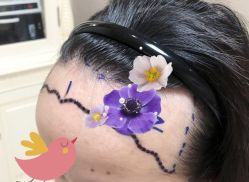 -大麦微针植发全国连锁