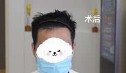 -大麦微针植发全国连锁