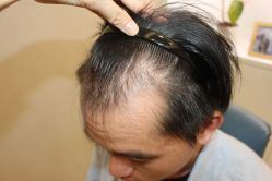 -大麦微针植发丨全国连锁