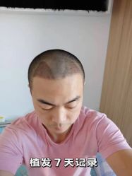 -雍禾植发