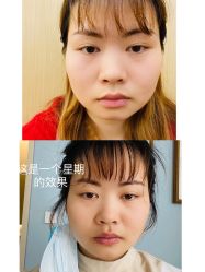 体验后-成都艾特他整形外科医院