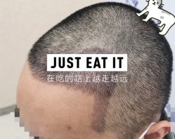 -大麦微针植发全国连锁