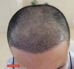 -大麦微针植发丨全国连锁