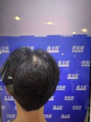 -碧莲盛·不剃发植发
