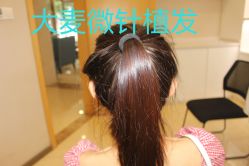 -大麦微针植发丨全国连锁