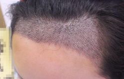 -大麦微针植发丨全国连锁