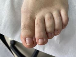-德哥灰指甲脚气甲沟炎跖疣护理
