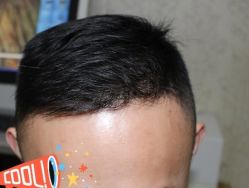 -大麦微针植发丨全国连锁