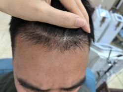 -大麦微针植发全国连锁