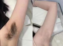 -薇兰专业脱毛连锁机构