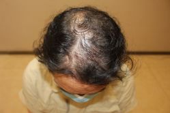 -大麦微针植发丨全国连锁