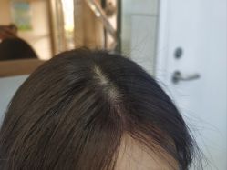 -碧莲盛·不剃发植发