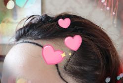 -大麦微针植发全国连锁