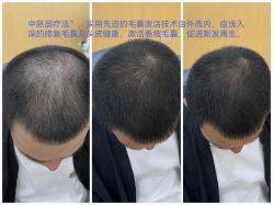 -菩叶脱发白发中心