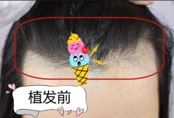-大麦微针植发全国连锁