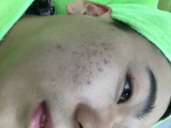 -苗医生草本科技祛痘