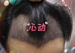 -大麦微针植发全国连锁
