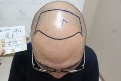 点击看大图 -大麦微针植发丨全国连锁