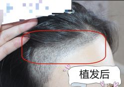 -大麦微针植发全国连锁