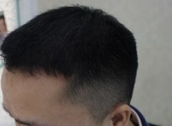 -大麦微针植发全国连锁