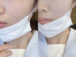 体验前-比华利美容医院